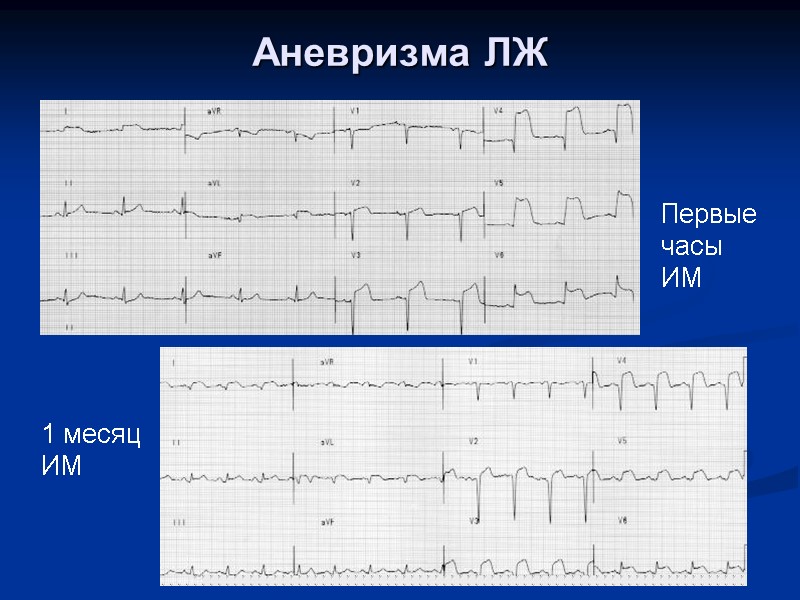 Аневризма ЛЖ Первые часы ИМ 1 месяц ИМ